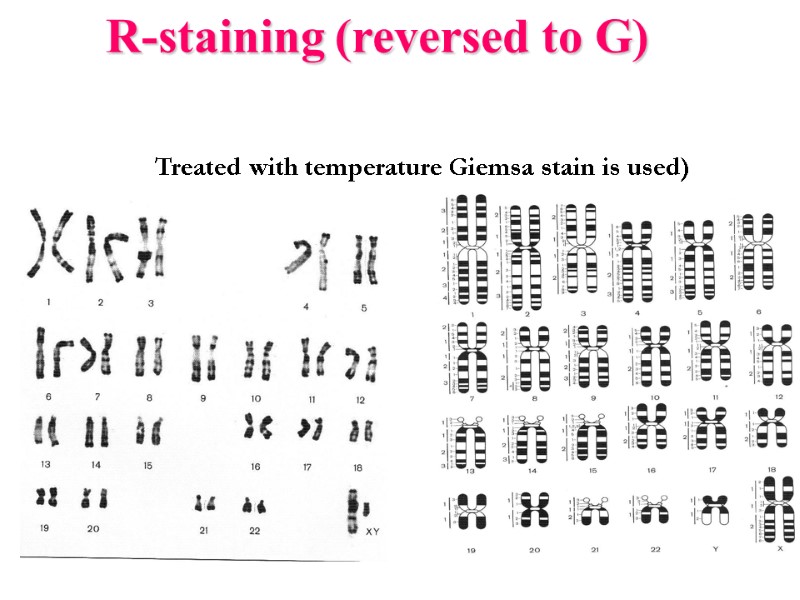 R-staining (reversed to G)  Treated with temperature Giemsa stain is used)